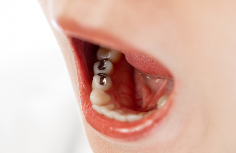 詰め物・被せ物の治療